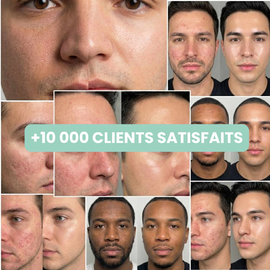 Peel Shotp Coréen – Transforme ta peau, élimine les points noirs