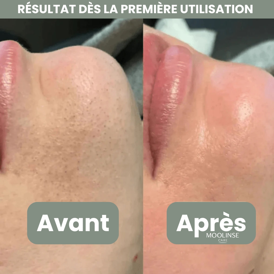 Peel Shotp Coréen – Transforme ta peau, élimine les points noirs