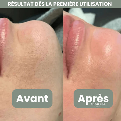 Peel Shotp Coréen – Transforme ta peau, élimine les points noirs