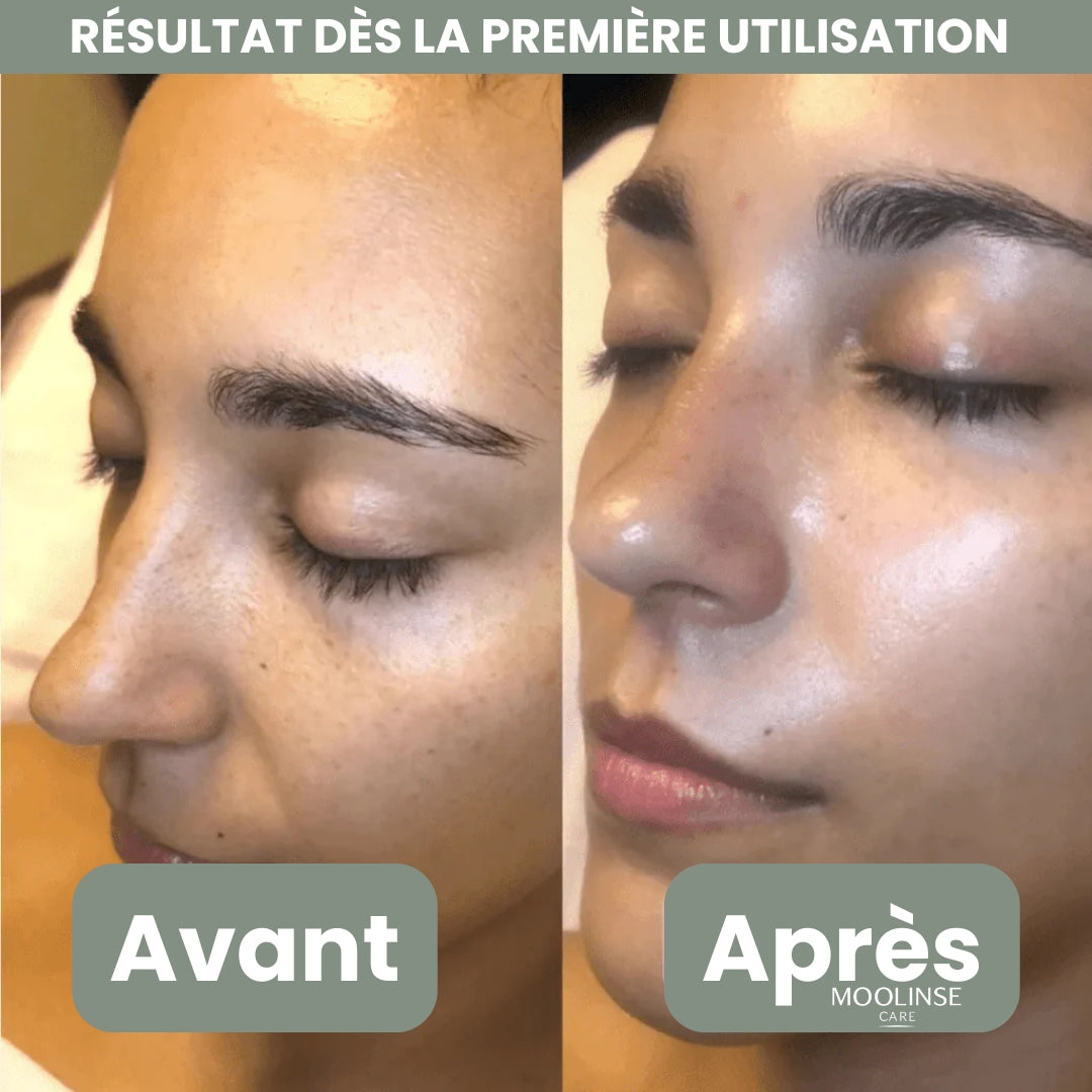Peel Shotp Coréen – Transforme ta peau, élimine les points noirs