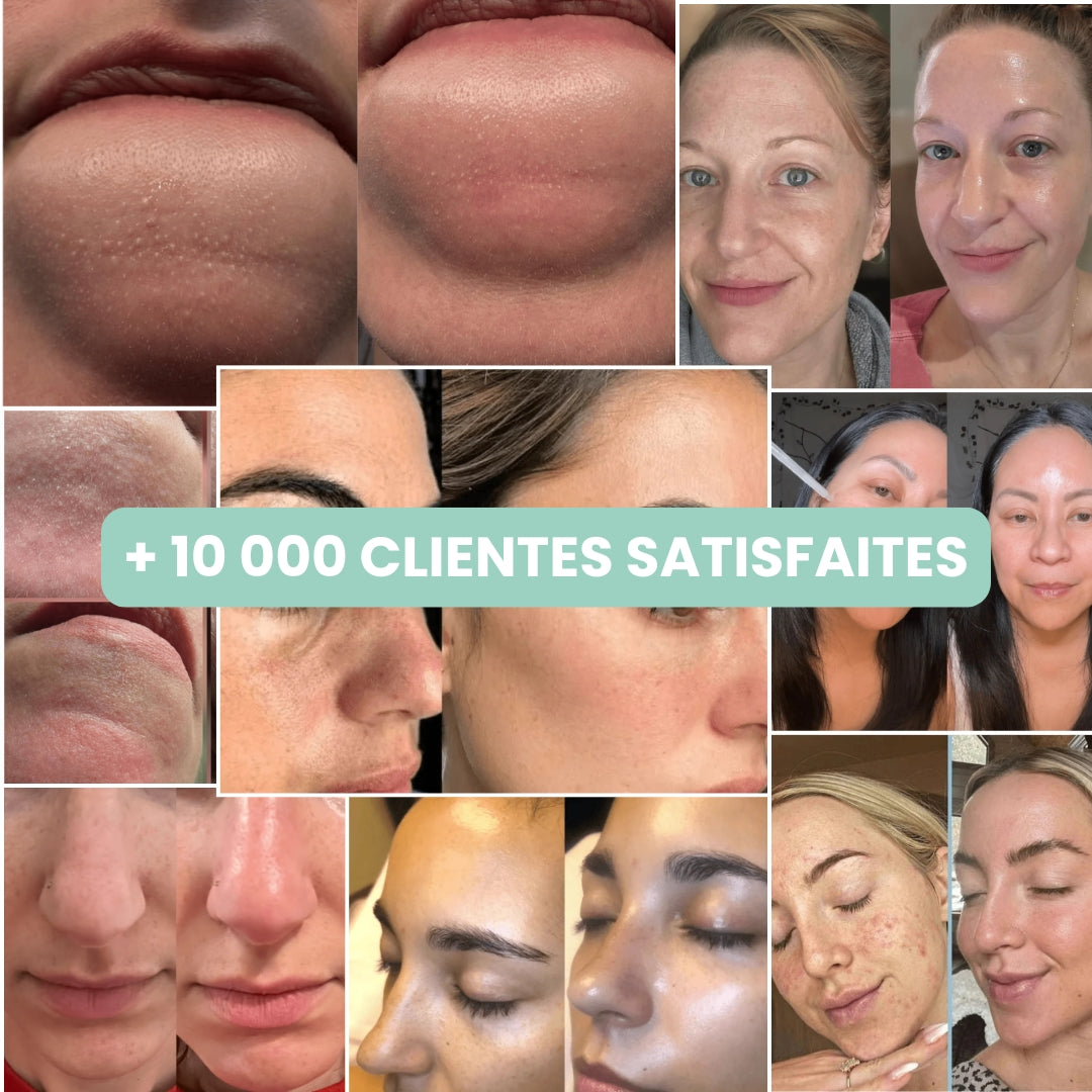 Peel Shotp Coréen – Transforme ta peau, élimine les points noirs