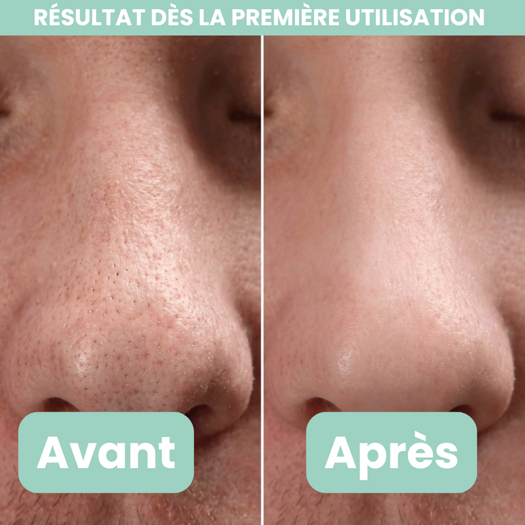 Peel Shotp Coréen – Transforme ta peau, élimine les points noirs