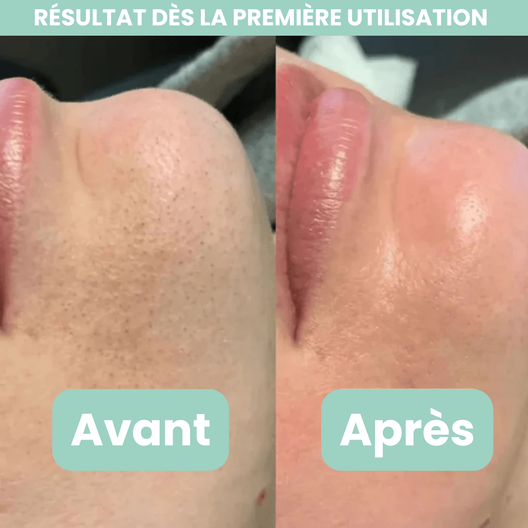 Peel Shotp Coréen – Transforme ta peau, élimine les points noirs