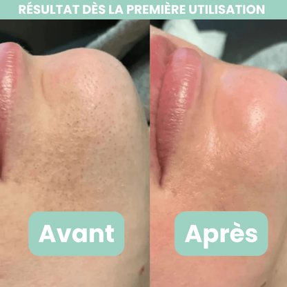 Peel Shotp Coréen – Transforme ta peau, élimine les points noirs