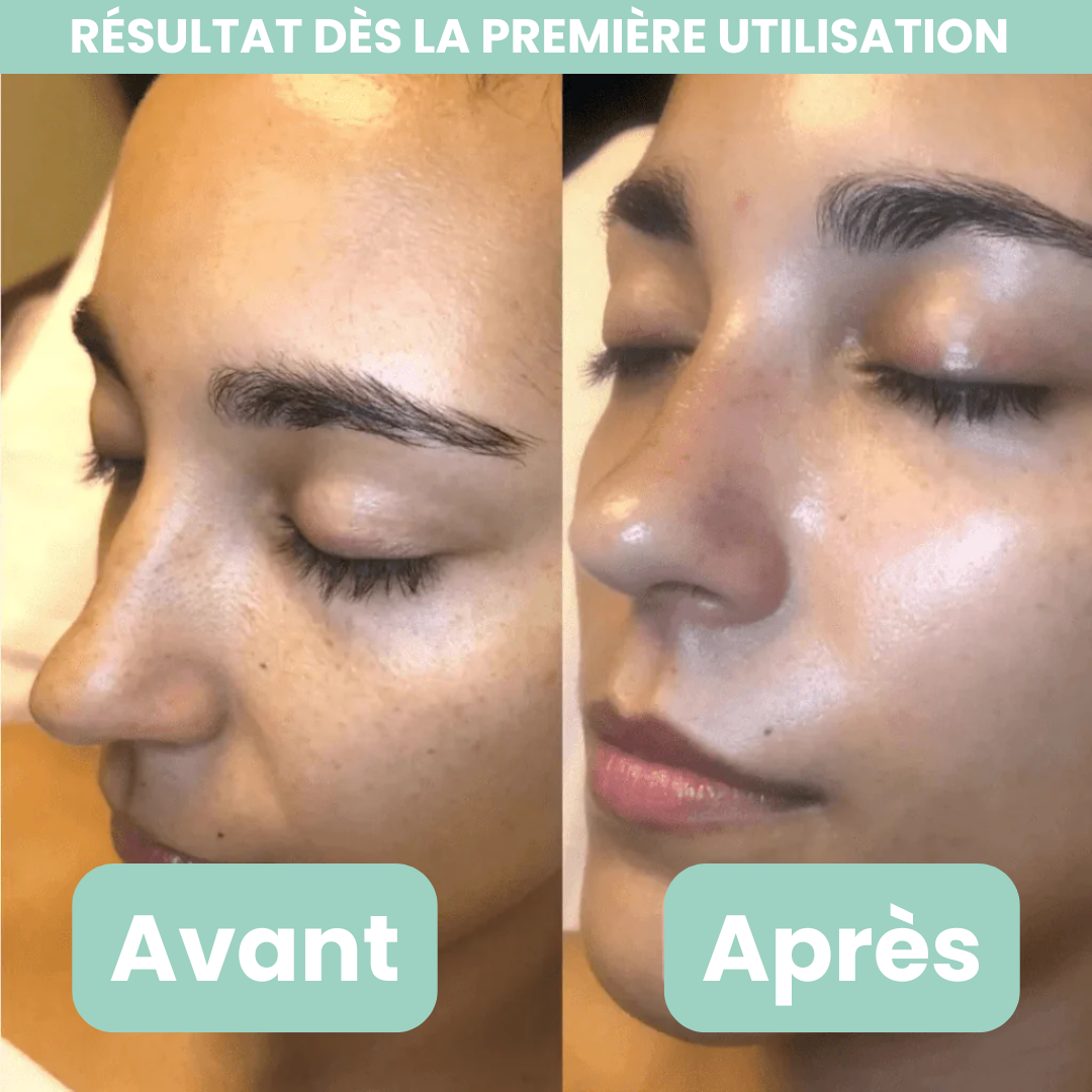 Peel Shotp Coréen – Transforme ta peau, élimine les points noirs