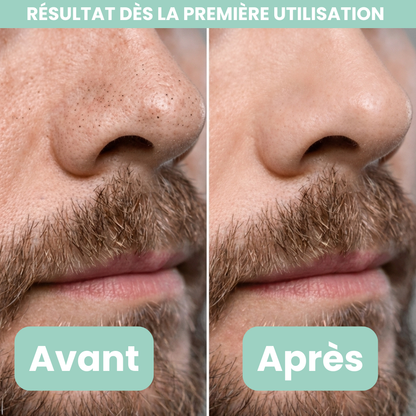 Peel Shotp Coréen – Transforme ta peau, élimine les points noirs