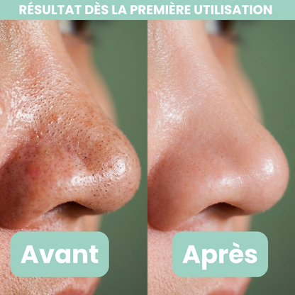 Peel Shotp Coréen – Transforme ta peau, élimine les points noirs